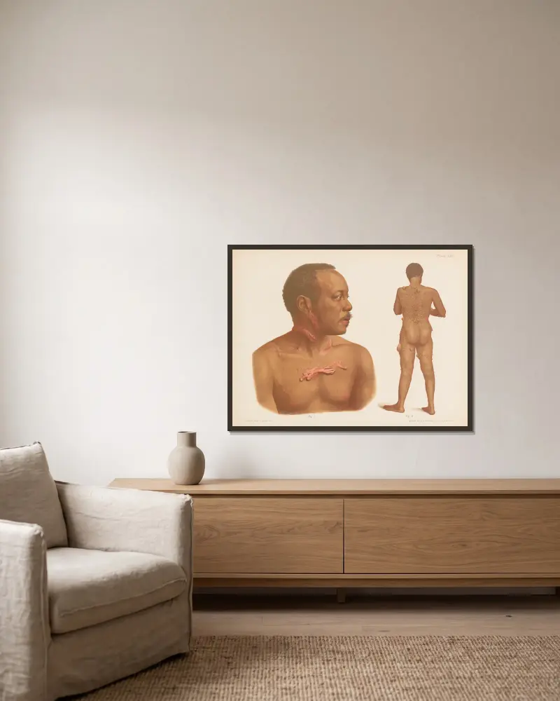 I. Keloid, II. Fibroma av Prince Albert Morrow inramad på en vägg
