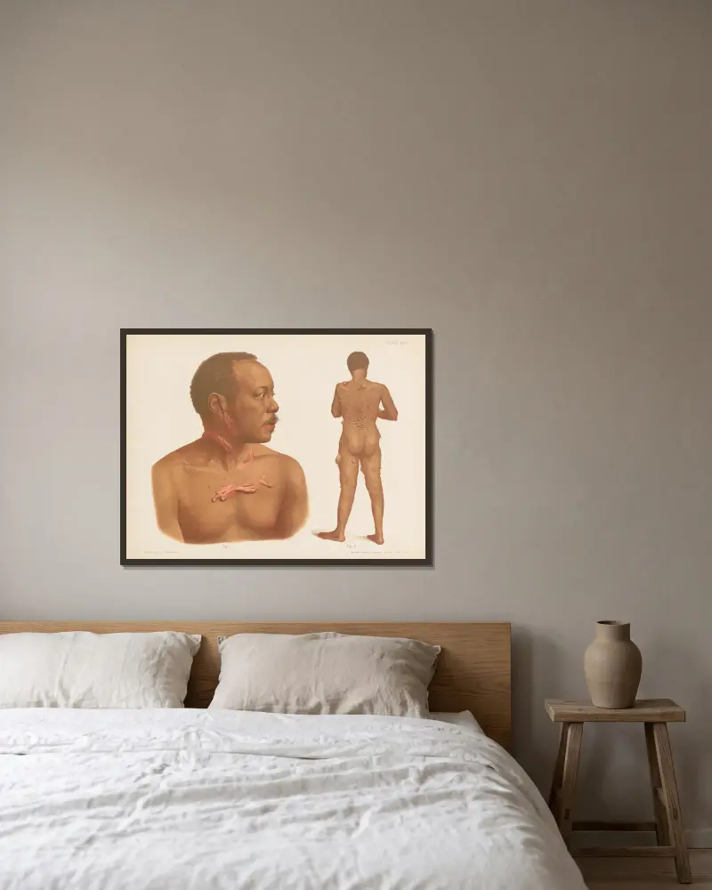 I. Keloid, II. Fibroma av Prince Albert Morrow inramad på en vägg