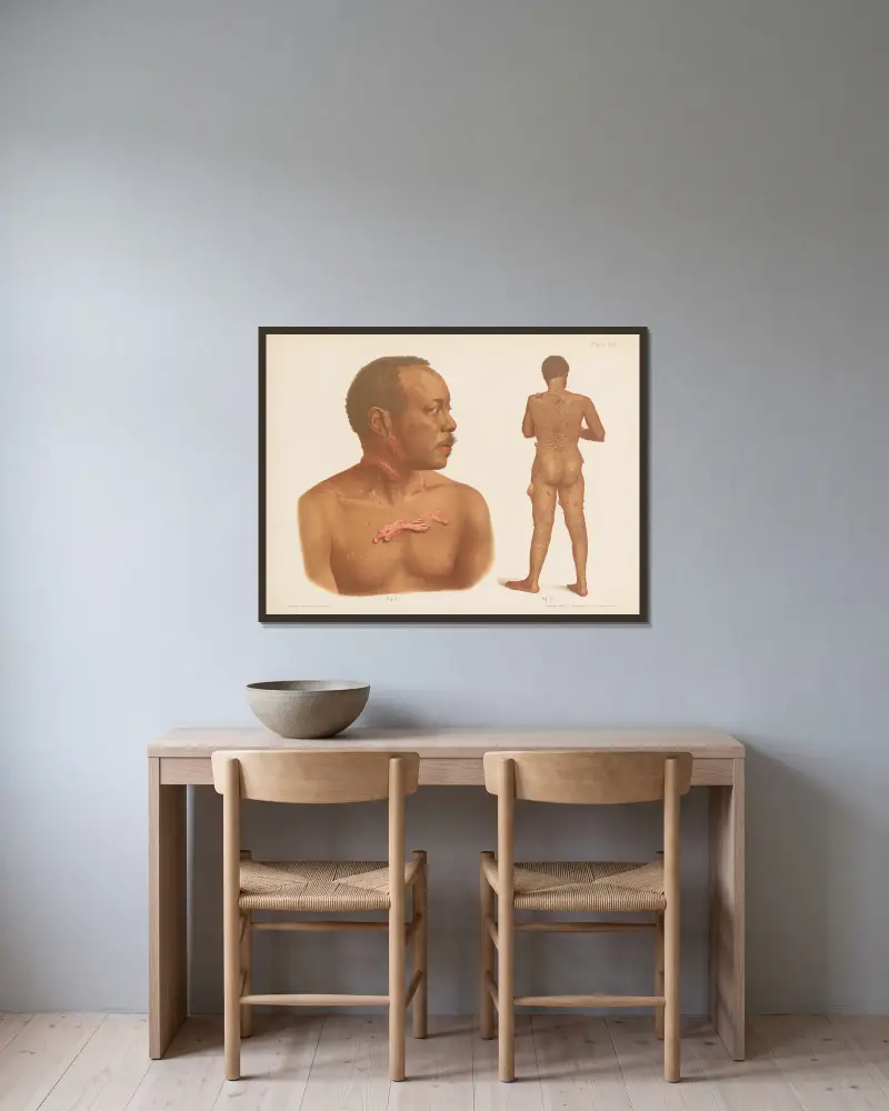 I. Keloid, II. Fibroma av Prince Albert Morrow inramad på en vägg