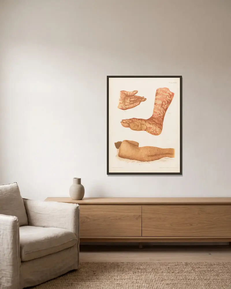 I. Pityriasis rubra of the leg and sole, II. Pityriasis rubra of the palm and nails, III. Dermatitis exfoliativa av Prince Albert Morrow inramad på en vägg