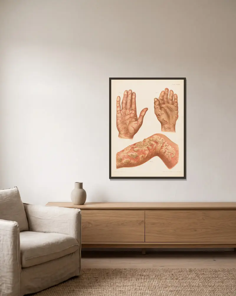 I. Psoriasis diffusa of the palm, II. Eczema of the palm, III. Eczema rubrum of the leg av Prince Albert Morrow inramad på en vägg