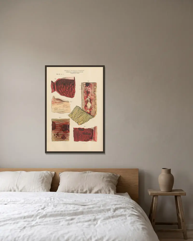 Haemorrhage of mucous membrane of the stomach from mechanical obstruction in the heart av Jean Allard Jeancon inramad på en vägg