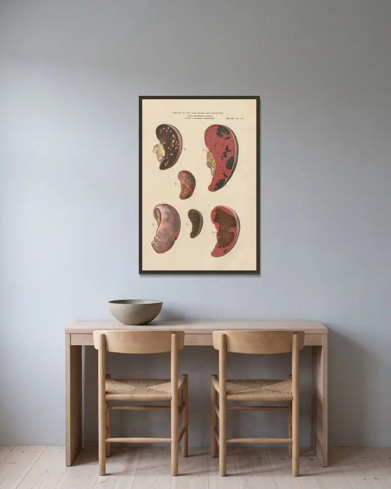 Splenitis and infarct, with abcesses av Jean Allard Jeancon inramad på en vägg