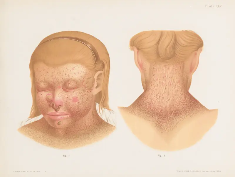 I. and II. Xeroderma pigmentosum av Prince Albert Morrow