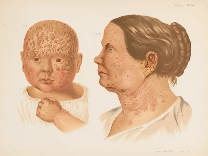 I. Eczema capitis, II. Eczema faciei av Prince Albert Morrow