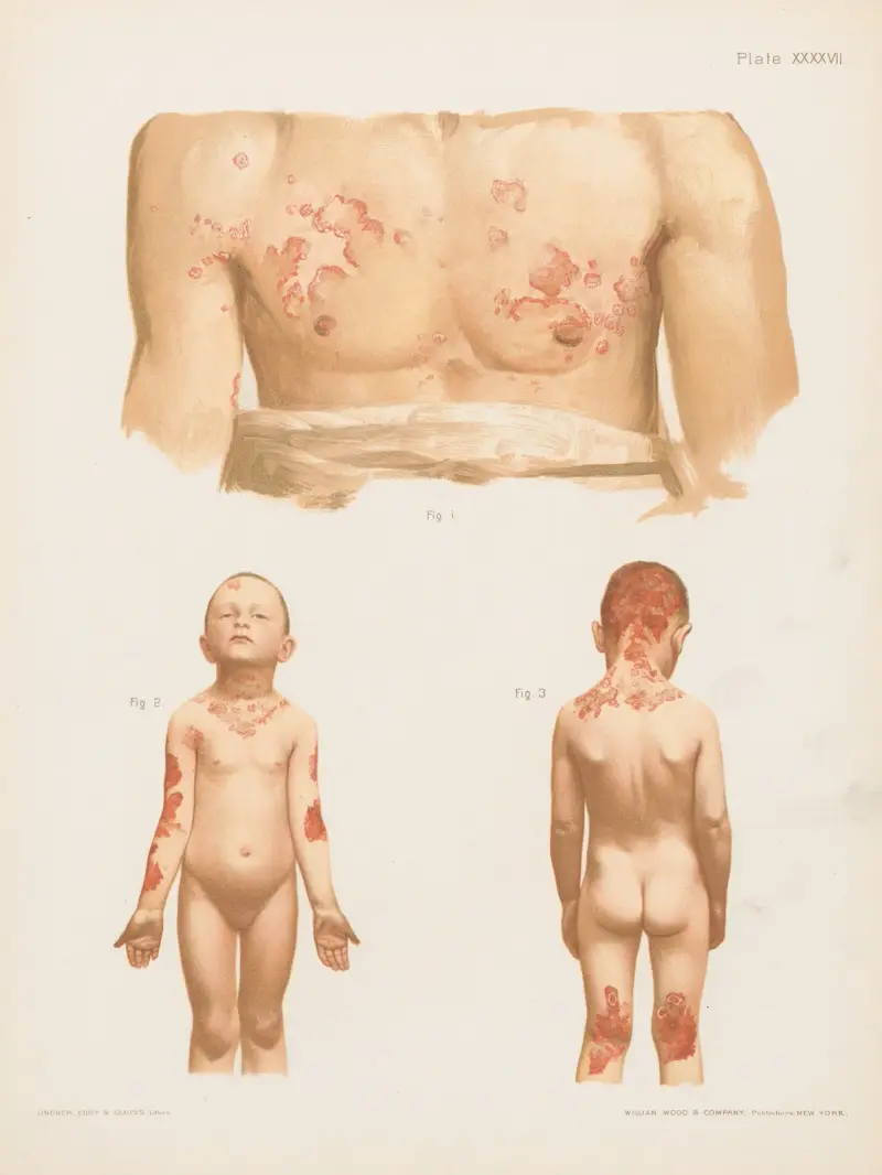 I. Eczema seborrhoicum of the breast and arms, II. and III. Eczema seborrhoicum universale av Prince Albert Morrow