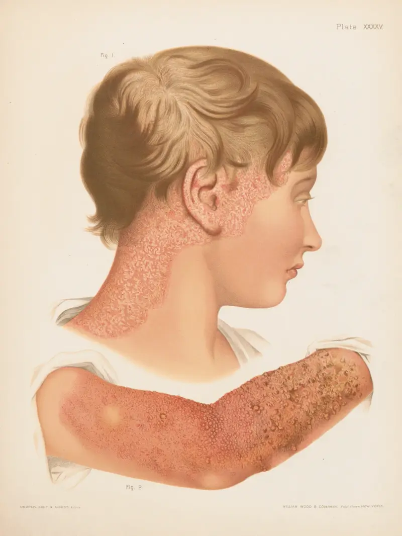 I. Eczema squamosum, II. Eczema papulosum, vesiculosum et impetiginosum av Prince Albert Morrow