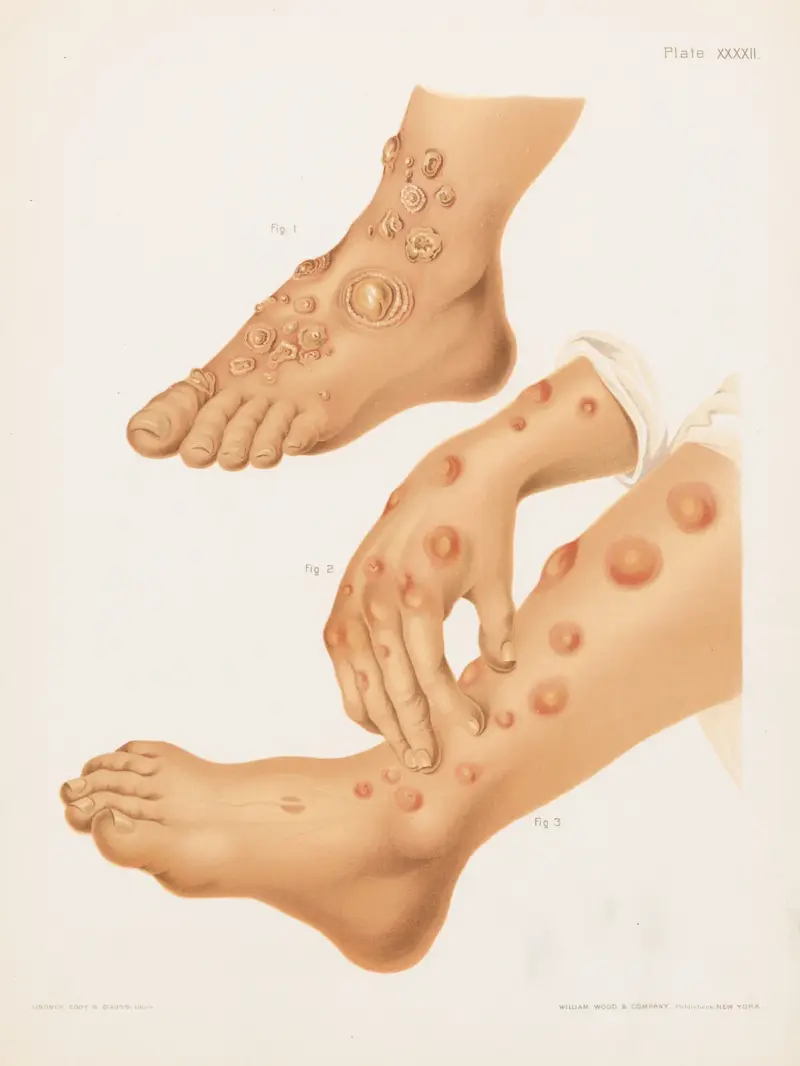 I. Herpes iris et circinatus, II. und III. Erythema nodosum. von Prince Albert Morrow