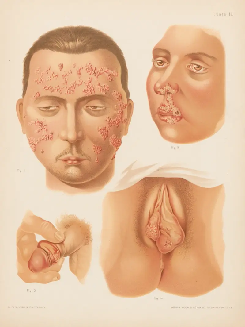 I. Herpes zoster (double), II. Herpes febrilis, III. Herpes of male genitals, IV. Herpes of female genitals av Prince Albert Morrow