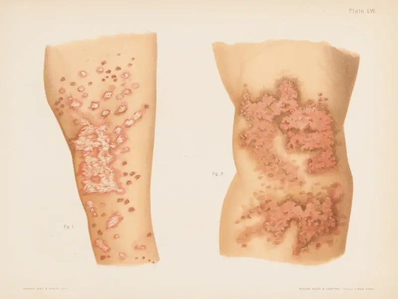 I. Lichen planus, II. Lichen planus von Prince Albert Morrow