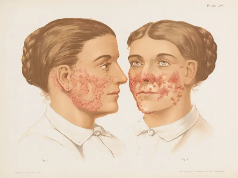 I. Lupus Erythematosus, II. Lupus Vulgaris av Prince Albert Morrow
