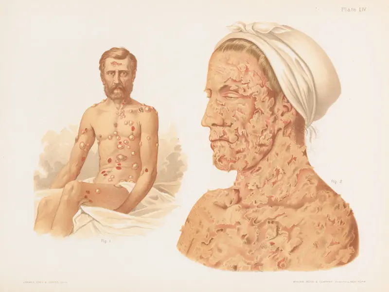 I. Pemphigus vulgaris, II. Pemphigus foliaceus av Prince Albert Morrow