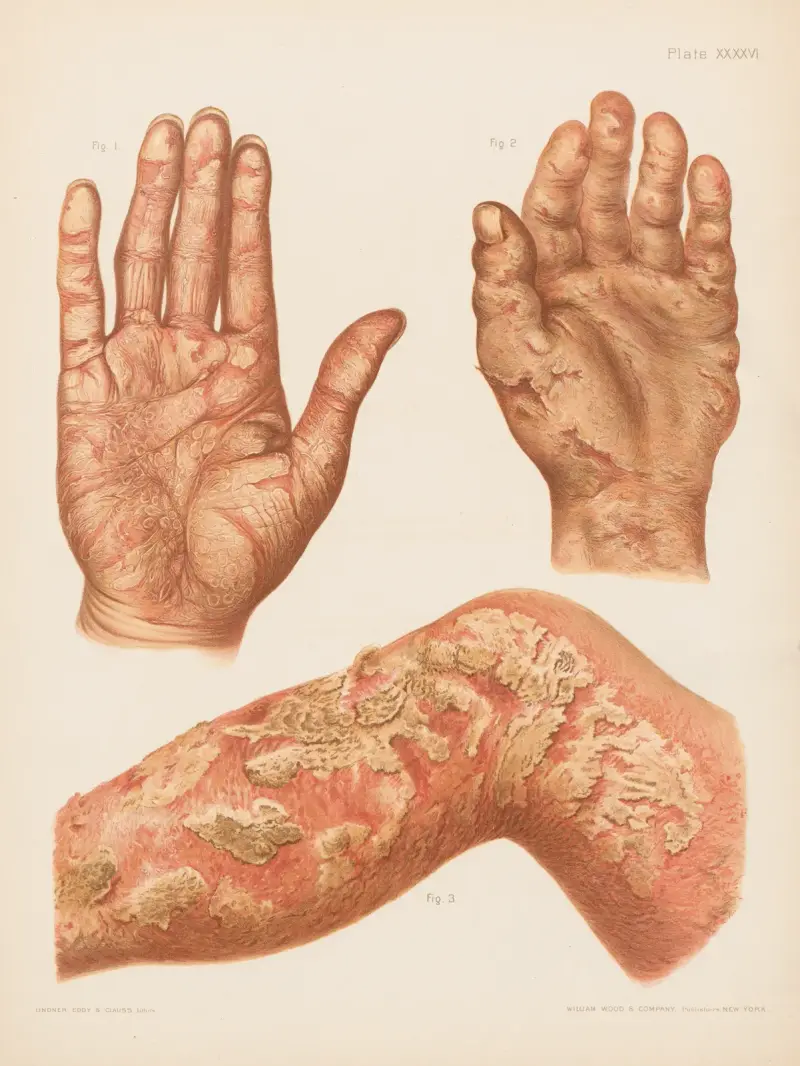 I. Psoriasis diffusa of the palm, II. Eczema of the palm, III. Eczema rubrum of the leg av Prince Albert Morrow