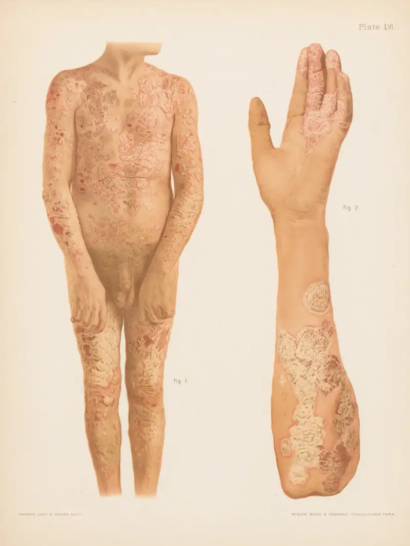 I. Psoriasis des Körpers, II. Psoriasis von Hand und Arm von Prince Albert Morrow