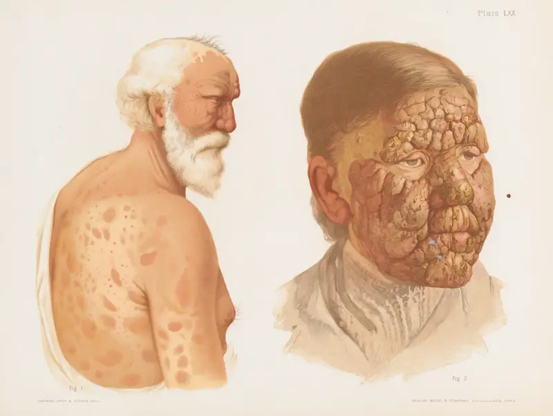 I. Tubercular Leprosy showing Macular Lesions, II. Tubercular Leprosy av Prince Albert Morrow