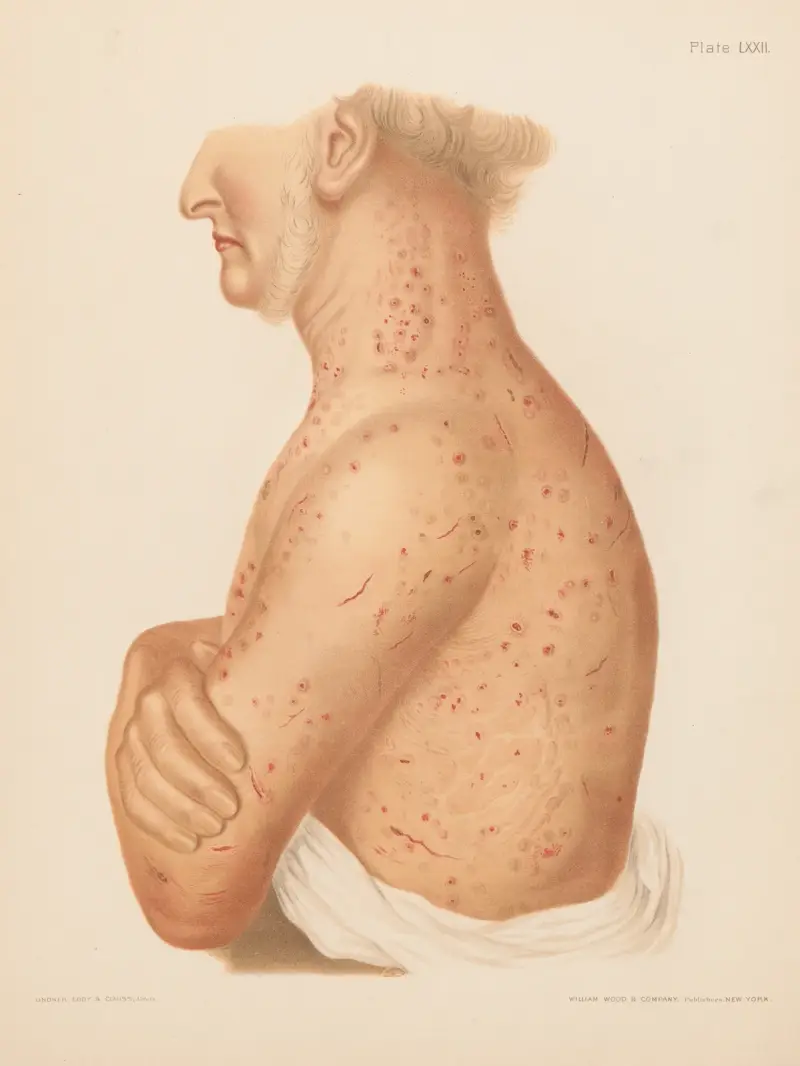 Pediculosis corporis von Prince Albert Morrow