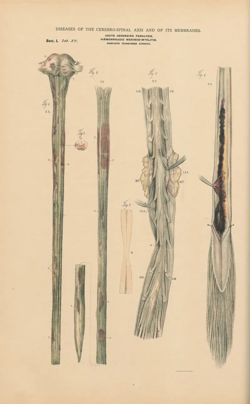 Acute ascending paralysis av Jean Allard Jeancon