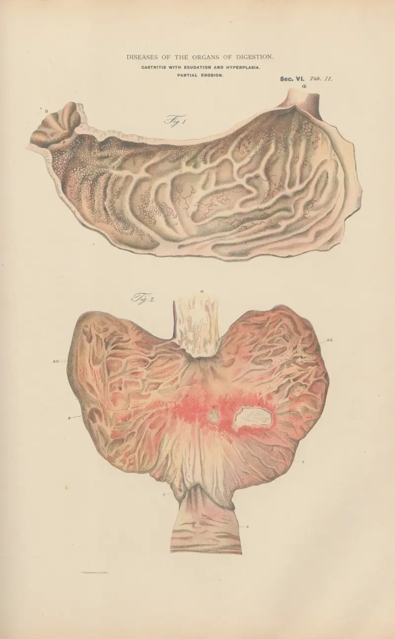 Acute catarrhal Gastritis, and hyperplasia av Jean Allard Jeancon