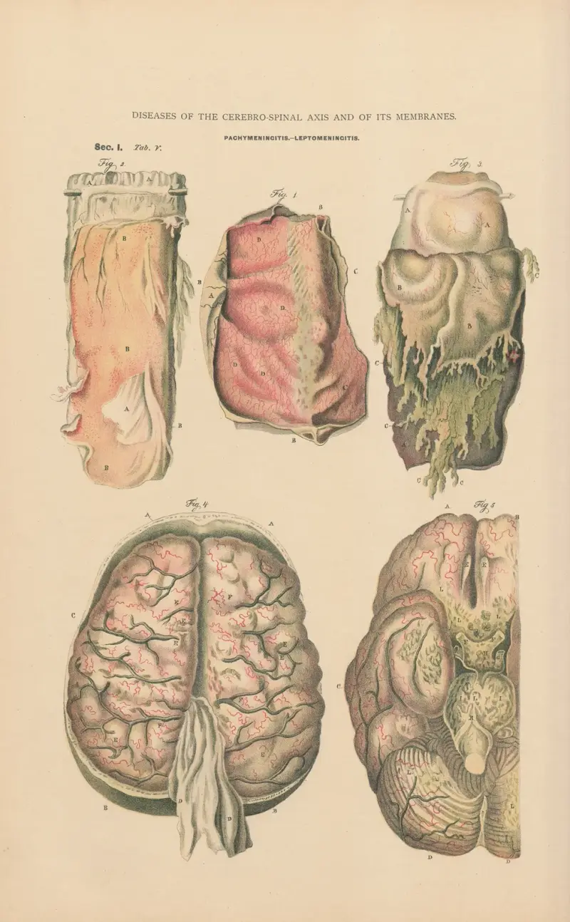 Akut hemorragisk pachymeningit och leptomeningit av Jean Allard Jeancon