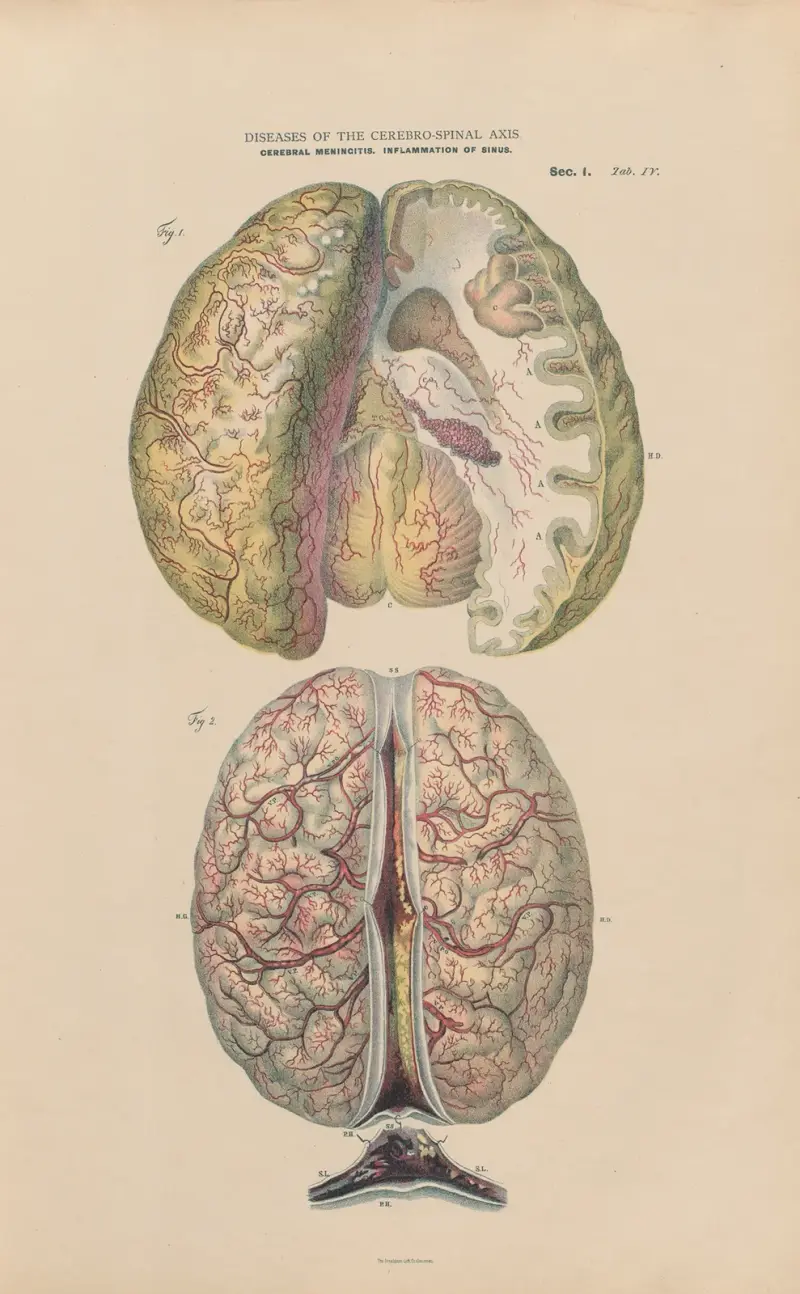 Acute sub-arachnoid meningitis av Jean Allard Jeancon