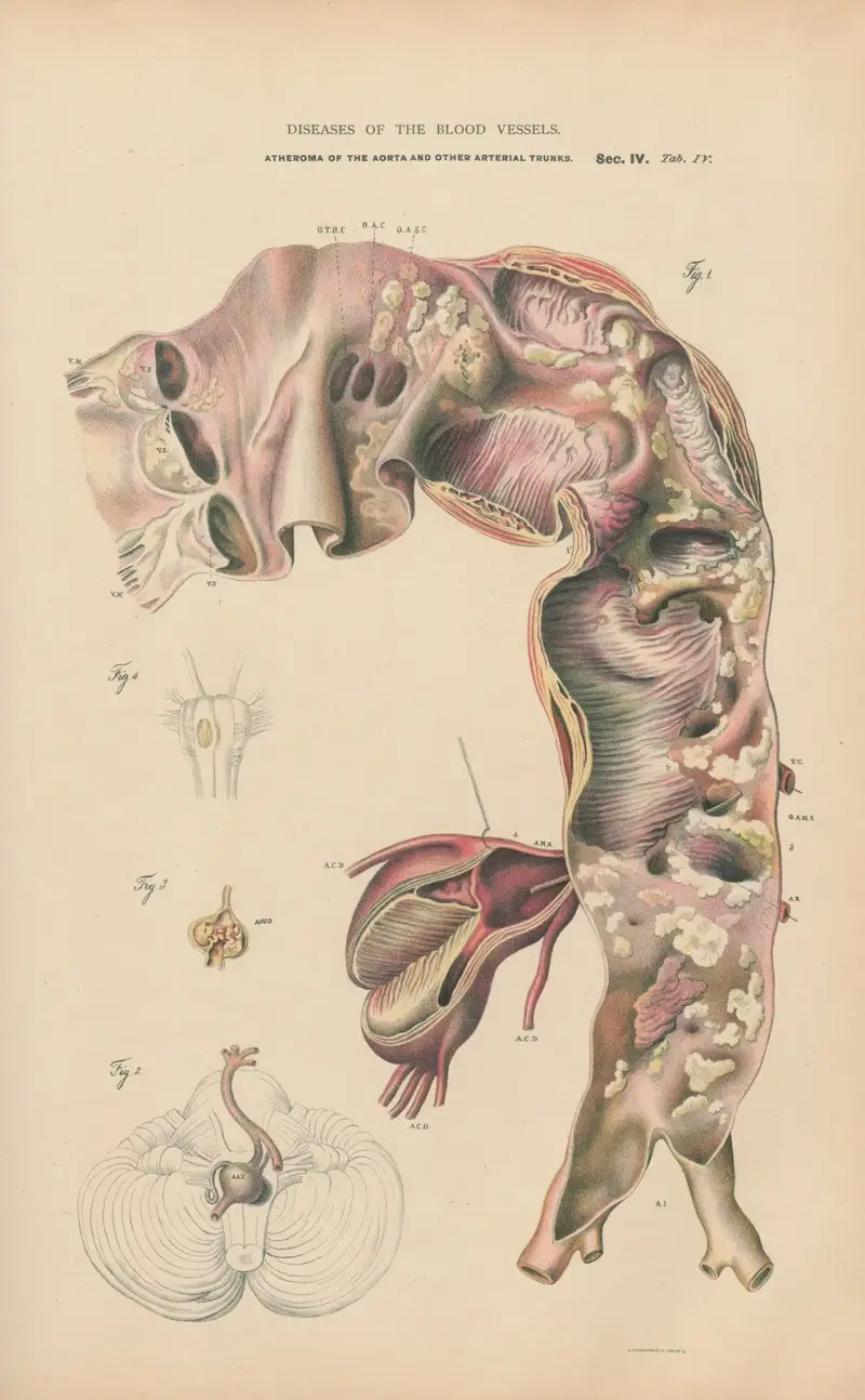 Atherom in Teilen der Aorta und der Arterienstämme von Jean Allard Jeancon