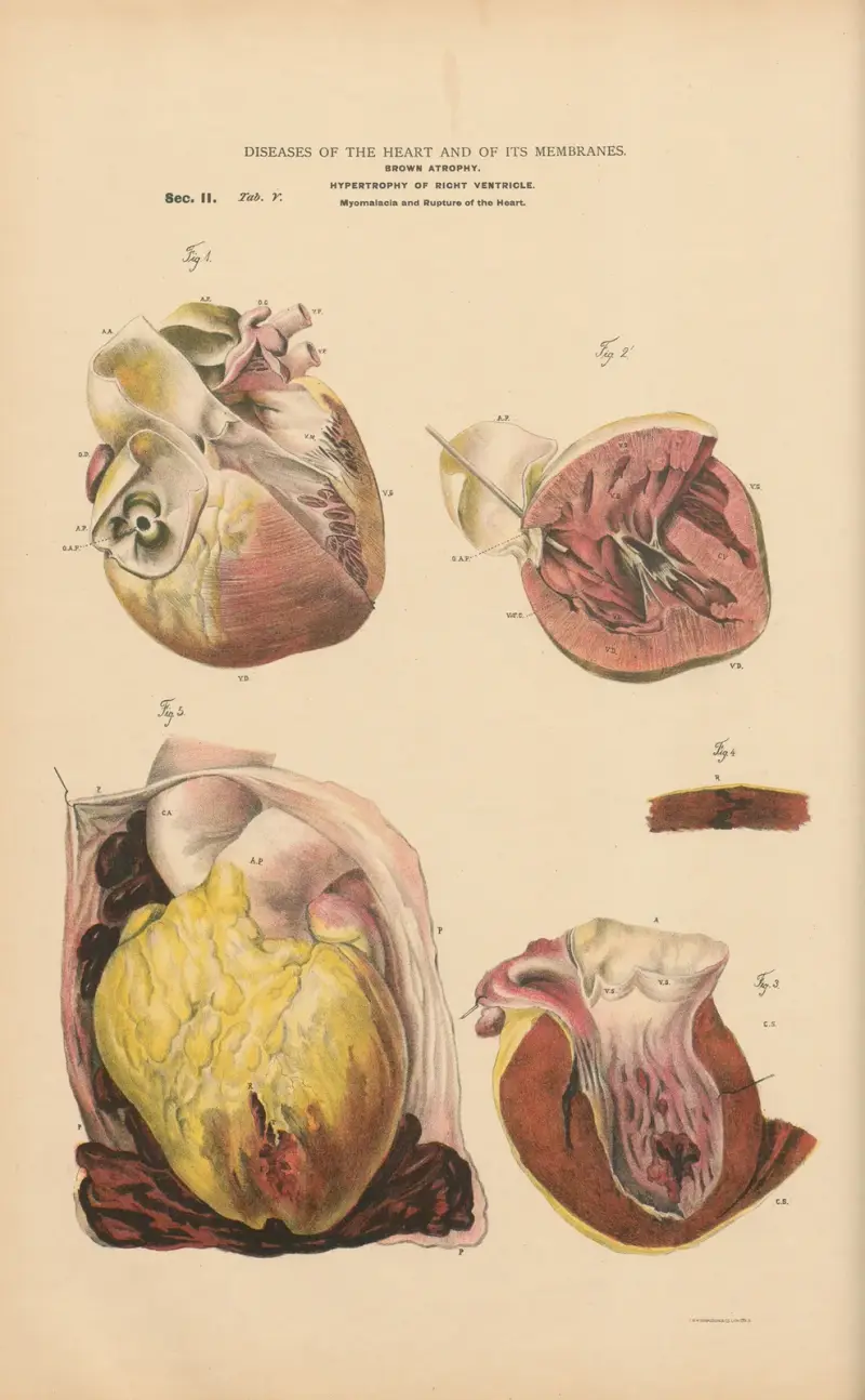 Brown atroyhy. Hypertrophy of right ventricle av Jean Allard Jeancon