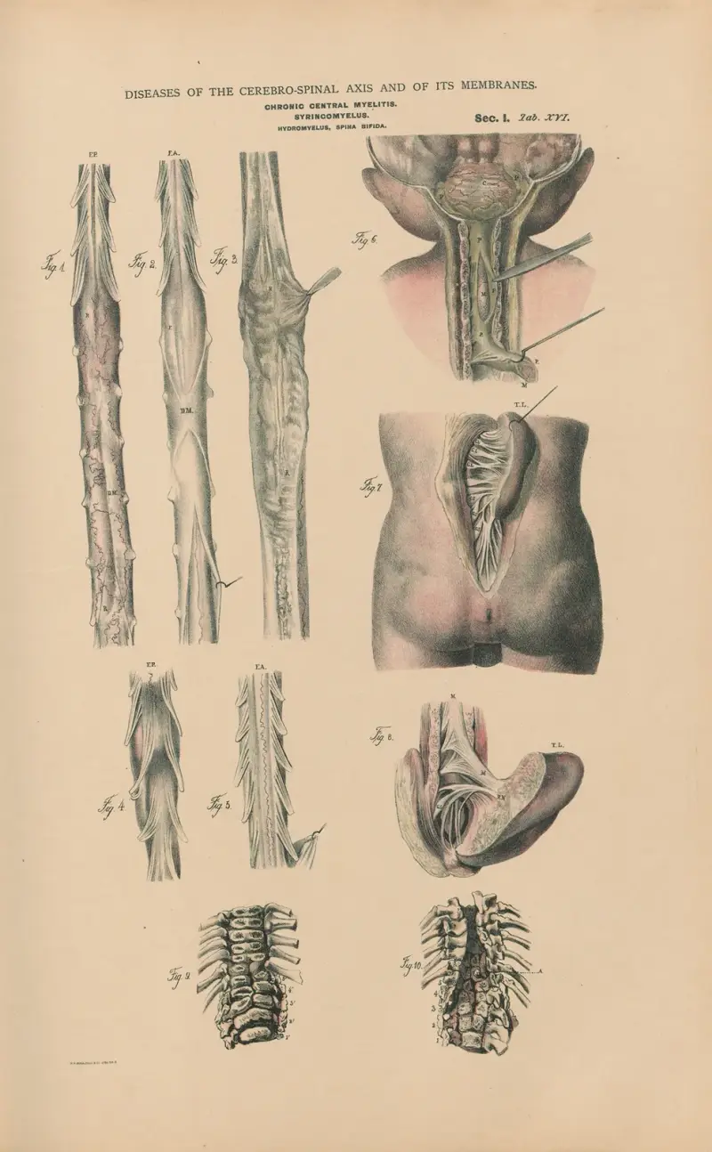 Kronisk central myelit. Hydromyelus, Spina bifida av Jean Allard Jeancon