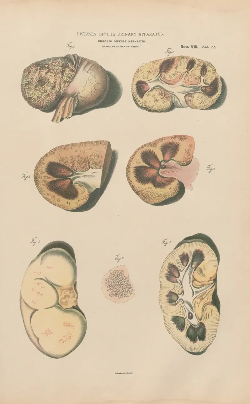 Chronická difuzní nefritida (Granulární ledvina), Jean Allard Jeancon