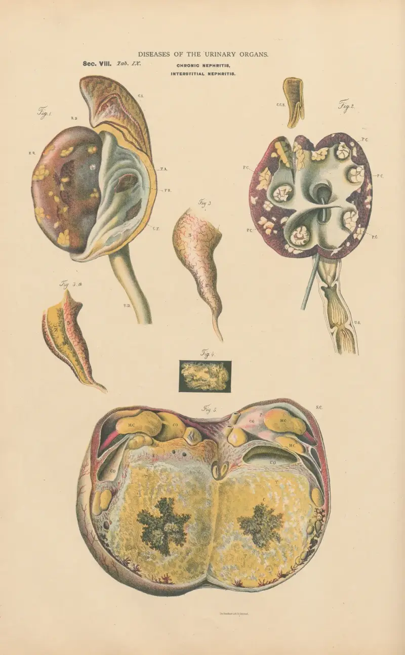 Chronic inflammation of right kidney and ureter. Cancer of kidney and ureter av Jean Allard Jeancon
