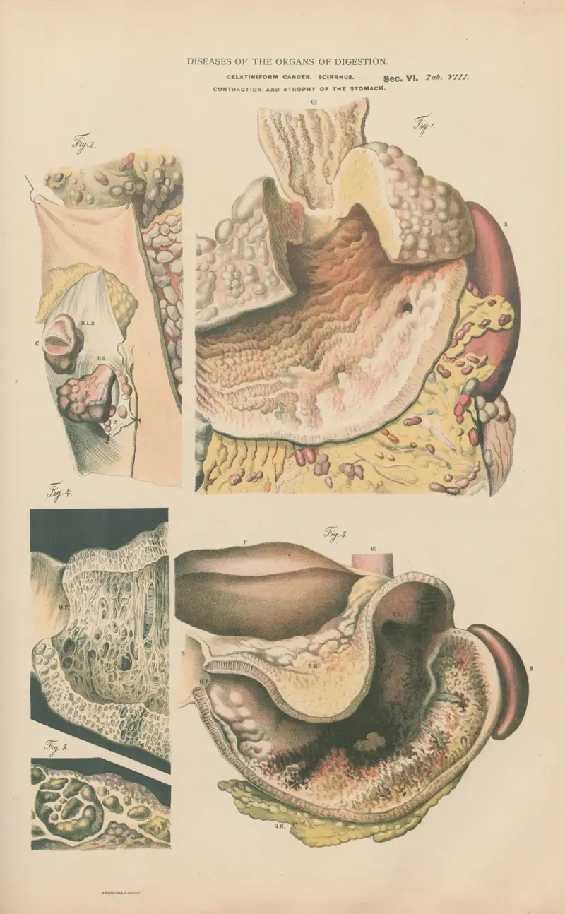 Colloid of stomach av Jean Allard Jeancon