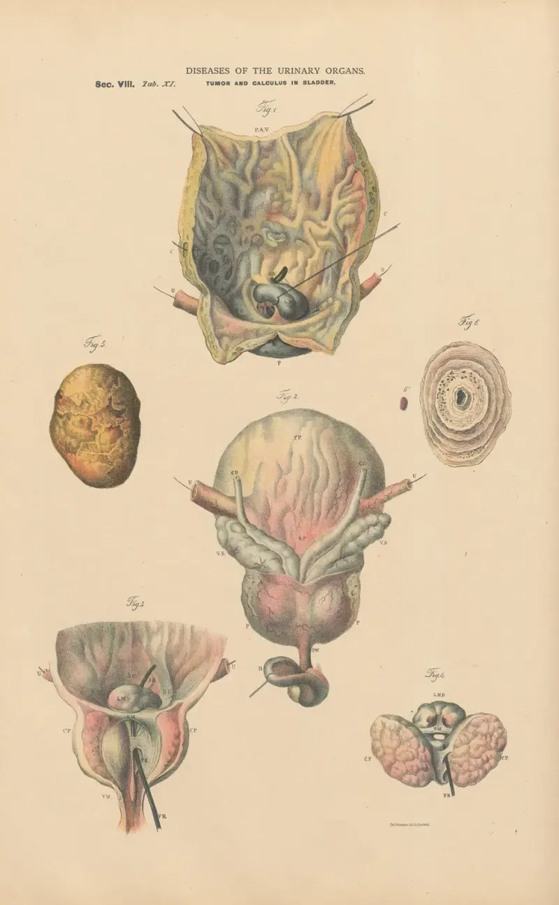 Cystitis. Tumor and uric acid calculus in the bladder av Jean Allard Jeancon