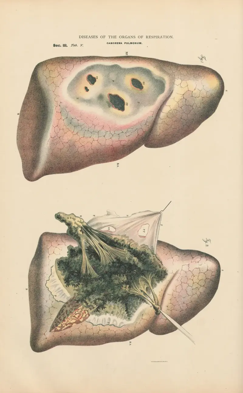 Diffuse Gangrene of right lung av Jean Allard Jeancon