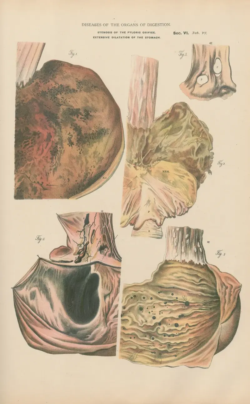 Gastric Lesions. Extensive delatation av Jean Allard Jeancon
