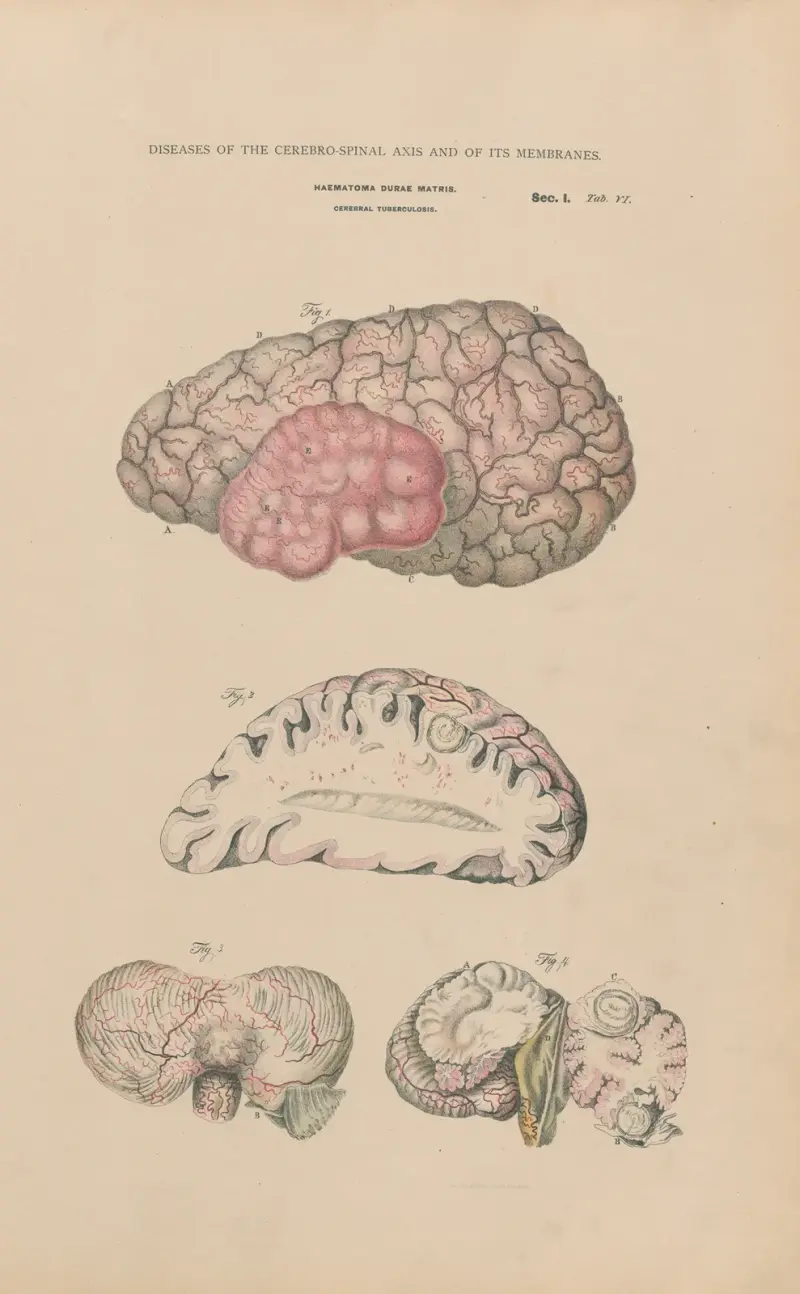 Haematoma. Tubercular meningitis av Jean Allard Jeancon