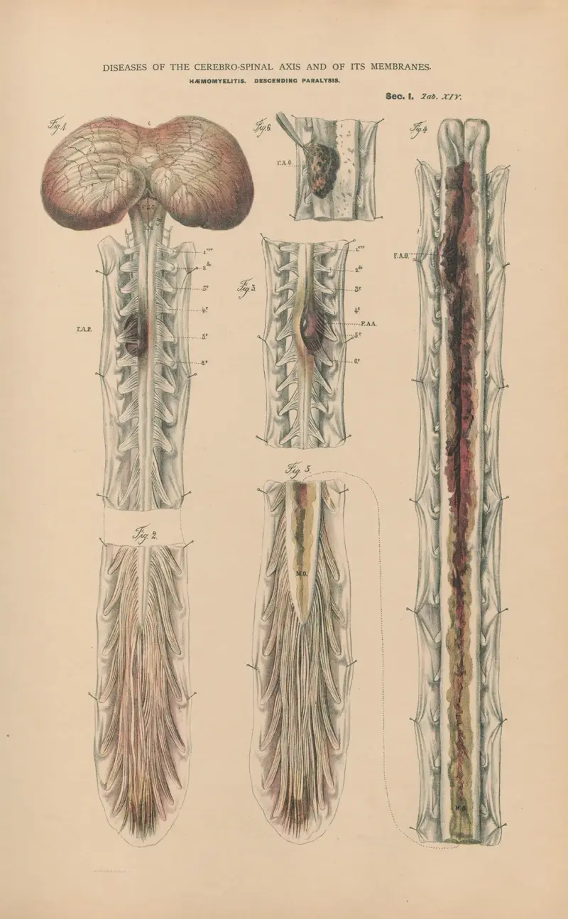 Haemomyelitis and descending paralysis av Jean Allard Jeancon