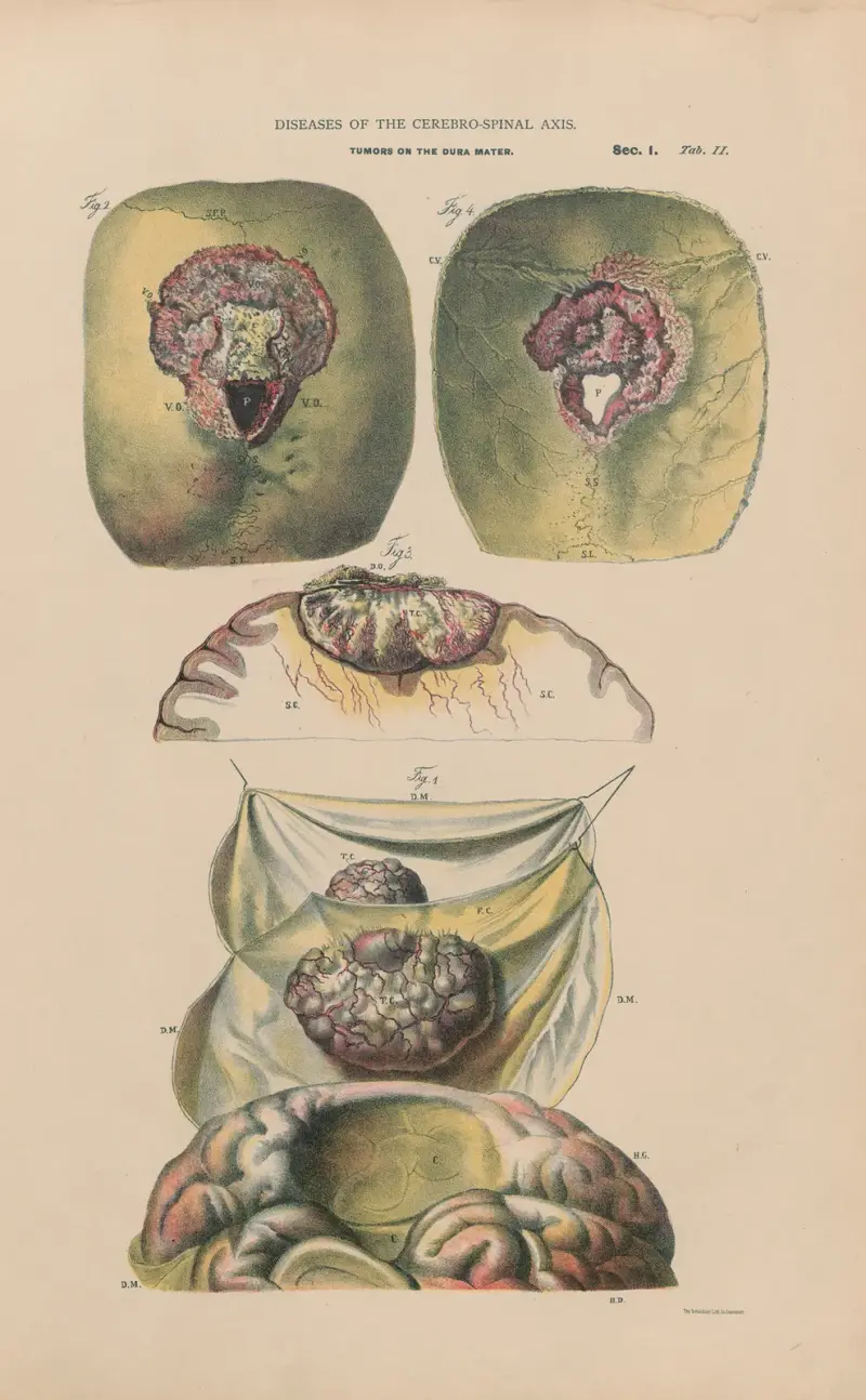 Hemiplegie, krebsartige Tumoren der Dura mater. Erweichung der Hirnsubstanz von Jean Allard Jeancon