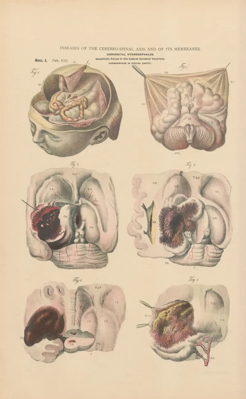 Hydrocephalus and microcephalus av Jean Allard Jeancon