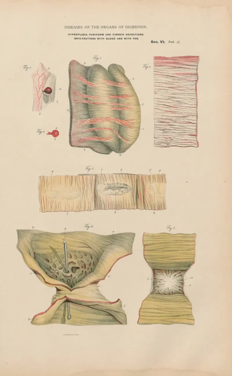 Hyperplastic formations, infiltrations, &c. av Jean Allard Jeancon