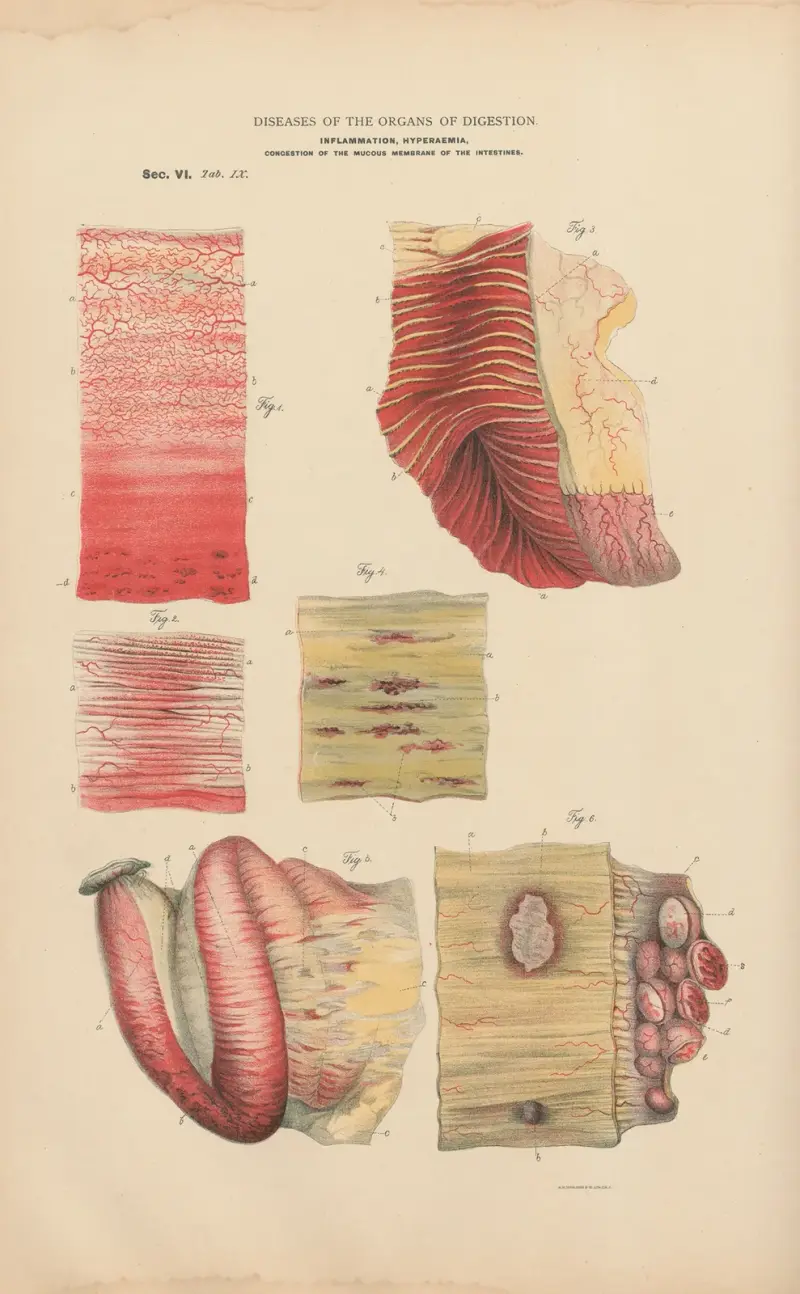 Inflammation, Hyperæmia, congestion, Ulceration of the mucous membranes of the intestines av Jean Allard Jeancon