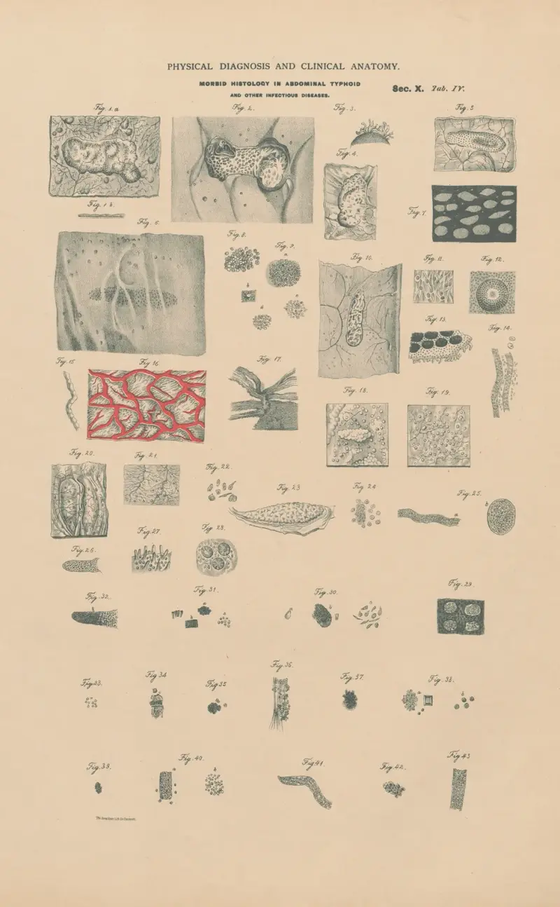 Morbid histology of abdominal typhoid, scarlet fever. Tuberculosis, Gangrene &c. av Jean Allard Jeancon