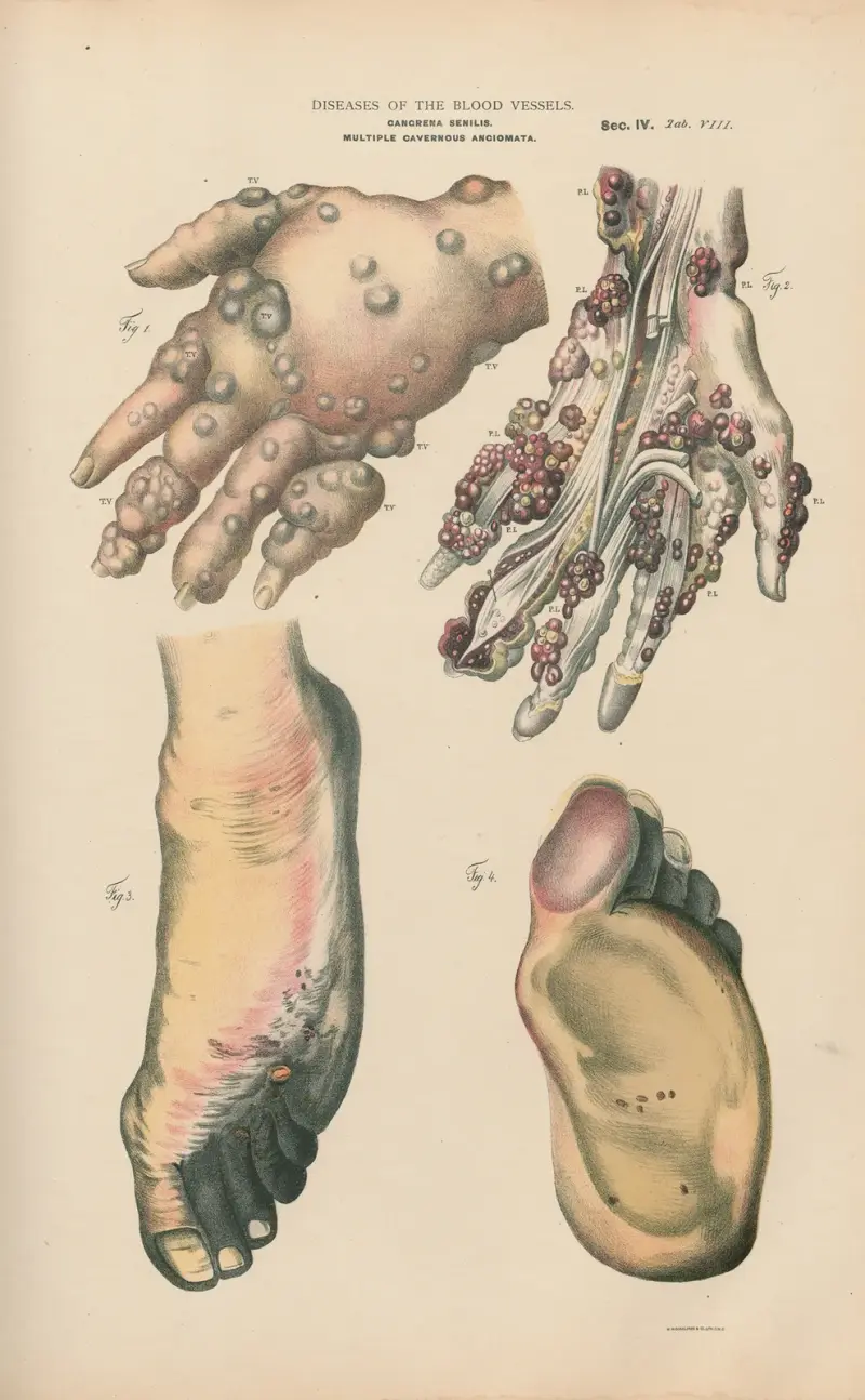 Multiple cavernous angiomata av Jean Allard Jeancon