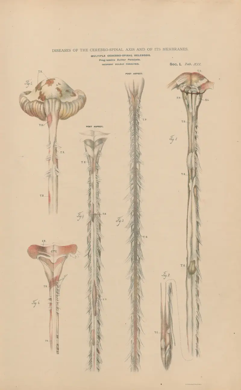 Multiple cerebro-spinal sclerosis, progressive bulbar paralysis. Incipient bulbar paralysis av Jean Allard Jeancon