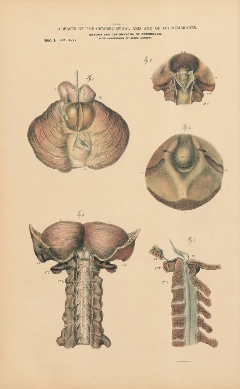 Myxomata in cerebellum. Slow compression of spinal cord, by displacement of Atlas av Jean Allard Jeancon