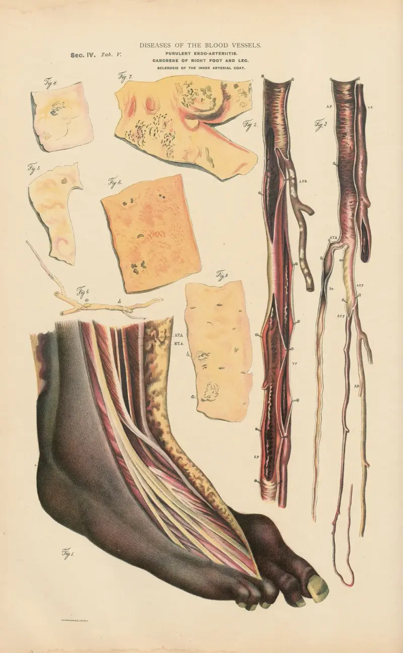 Eitrige Endoarteriitis der Femoralarterie von Jean Allard Jeancon