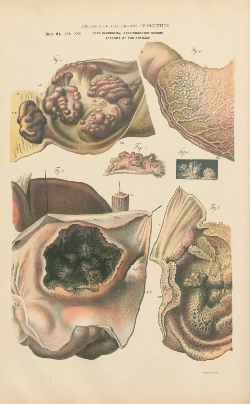 Weiches Epitheliom des Magens von Jean Allard Jeancon