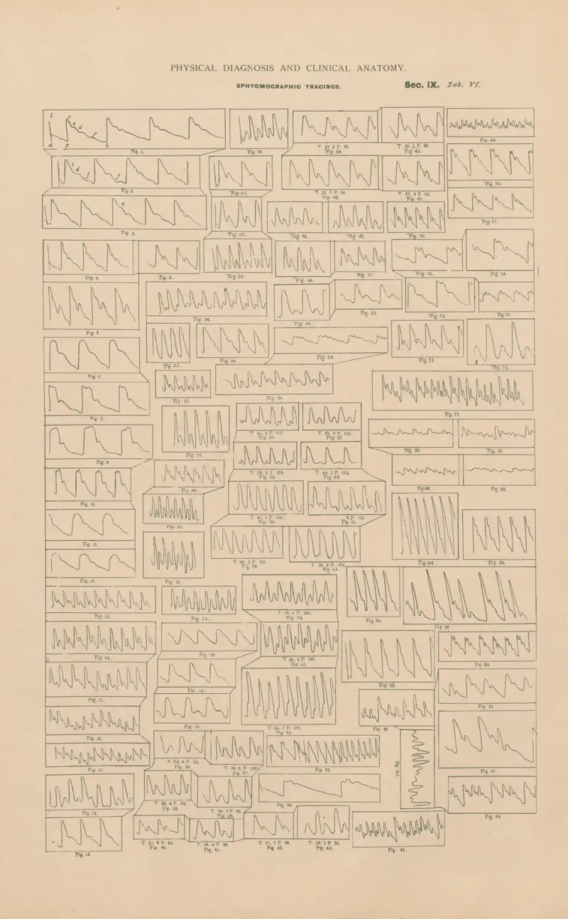 Sphygmographische Kurven von Jean Allard Jeancon