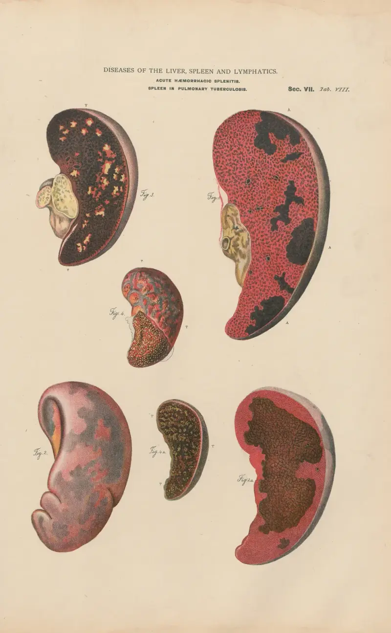 Splenitis and infarct, with abcesses av Jean Allard Jeancon