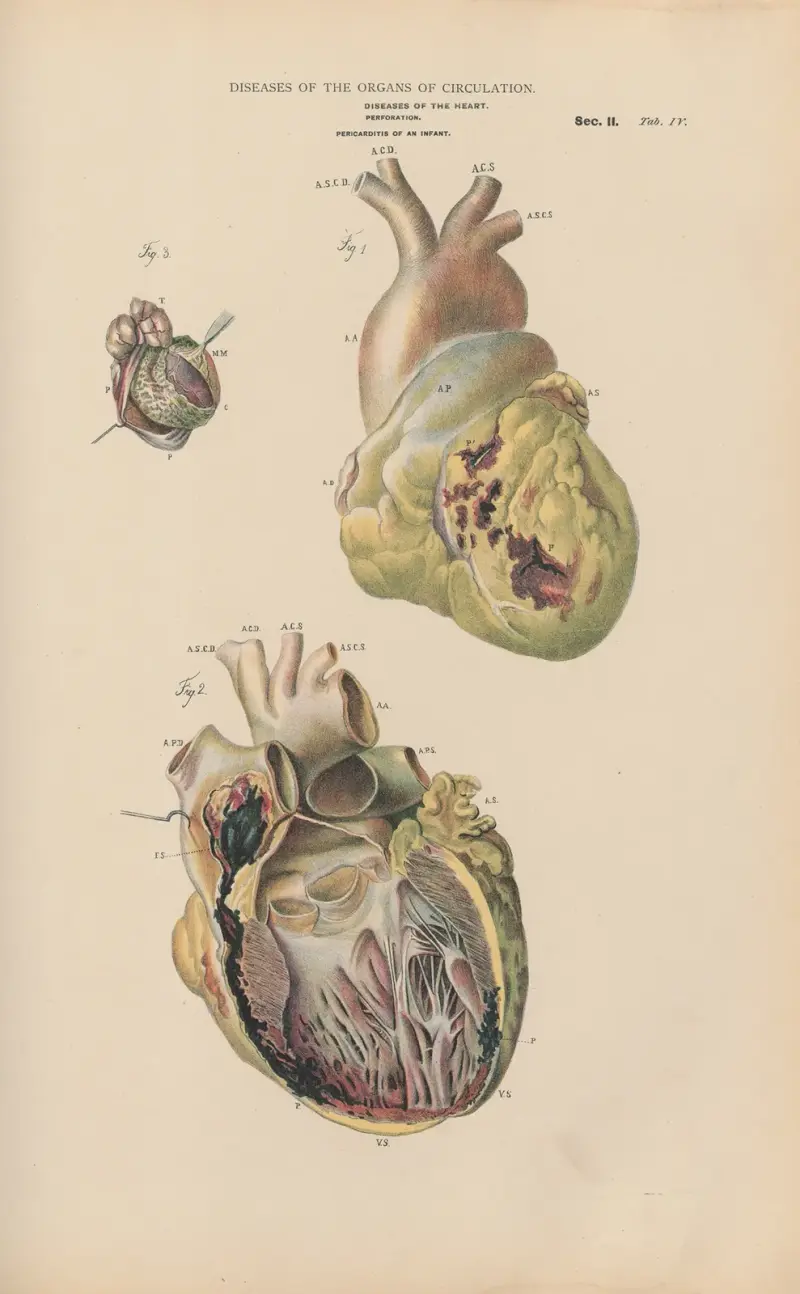 Spontaneous rupture of the heart av Jean Allard Jeancon