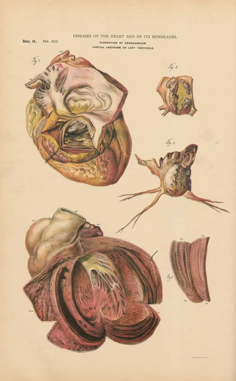 Ulceration av endokardiet av Jean Allard Jeancon