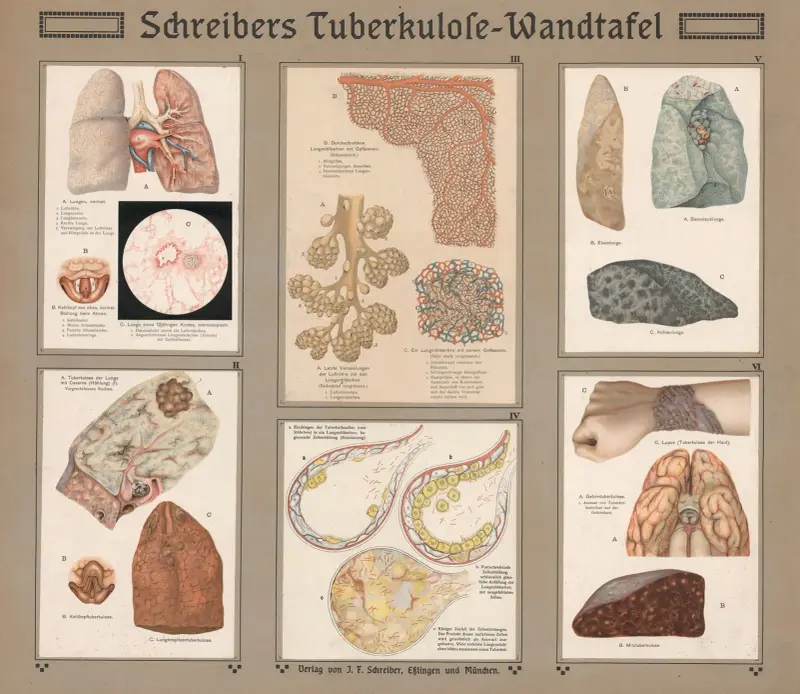 Schreiberova tabulka tuberkulózy, J.F. Schreiber